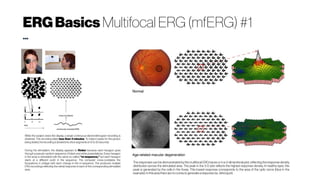 ERGBasics Multifocal ERG (mfERG) #1
...
The responses can be demonstrated by the multifocal ERG traces or in a 3-dimentional plot, reflecting the response density
distribution across the stimulated area. The peak in the 3-D plot reflects the highest response density. In healthy eyes, this
peak is generated by the cells in the fovea. This lowest response corresponds to the area of the optic nerve (blue in the
example). Inthisareathere are noconesto generate aresponse(i.e., blind spot).
While the subject views the display, a single continuous electroretinogram recording is
obtained. This recording takes less than 4 minutes. To make it easier for the person
being tested,therecording isdividedinto shortsegmentsof 15 to 30 seconds.
During the stimulation, the display appears to flicker because each hexagon goes
through a pseudo-random sequence of black and white presentations. Every hexagon
in the array is stimulated with the same so-called “m-sequence,” but each hexagon
starts at a different point in the sequence. The computer cross-correlates the
fluctuations in voltage with each change in the m-sequence. The produces multiple
ERG recordings reflecting the retinal response of each of the corresponding stimulated
area.
 