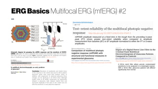 ERGBasics Multifocal ERG (mfERG) #2
...
Schematic diagram for grouping the mfERG responses and the waveform of MOFO
mfERG. Left: Both DC and IC responses were pooled into concentric rings with eccentricity
from ring 1 (0°) to ring 6 (19.20°) Right: Schematic diagram for DC amplitude and implicit
time, IC amplitude and implicit time of global flash mfERG. Chin et al. (2015)
http://iovs.arvojournals.org/article.aspx?articleid=2270706
Conclusion: Alterations of amplitudes and implicit times
of N2 response in the central area may be able to detect
glaucoma earlier than visual field analyses (VFA). In
addition, with progression to advanced glaucoma these
changes can be significant in all retinal areas. Although
implicit times of all mfERG components are significantly
delayed in glaucoma, both delayed implicit time and
decreased amplitude of N2 wave in the central area are
effective predictors in early glaucoma diagnosis.
http://dx.doi.org/10.1007/s10633-016-9524-3
http://dx.doi.org/10.3109/02713683.2014.1002043
A 50 Hz notch filter allows grossly contaminated
waveforms to be analyzed in a meaningful manner.
With a 50 Hz filter, glaucoma patients still differed
significantly from normal.
http://dx.doi.org/10.1007/s10633-016-9569-3
mfPhNR amplitude measured at a fixed time in the trough from the preceding b-wave
peak (PT) shows greater test–retest reliability when compared to amplitude
measurement from baseline (BT) or BT amplitude normalized to either the PT or b-wave
amplitudes.
 