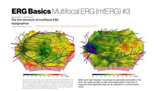 ERGBasics Multifocal ERG (mfERG) #3
http://jov.arvojournals.org/article.aspx?articleid=2121540
Our results reveal a fine structure in local responsiveness that is neither attributable to noise
contamination nor related to pathological changes in the retina. We conclude that some of the
small-scale local inhomogeneities in the response topography have an anatomical/optical, and
others a physiological origin. They are due in part to shadows cast by the retinal vasculature
and to local differences in response amplitude and dynamics. It is not known at this point
whether areas of depressed local amplitude might indicate regions that are more susceptible to
pathological changes within the retina or the underlying structures.
While such high resolution recordings are generally not feasible in the
clinic, the study provides us with some appreciation of the size of
response inhomogeneities that can be expected in a normal human
retina.
 