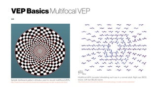 VEPBasics Multifocal VEP
...
Sample dartboard pattern stimulus used to record multifocal VEPs.
http://webvision.med.utah.edu/book/electrophysiology/visually-evoked-potentials/
Multifocal VEPs recorded stimulating each eye in a normal adult. Right eye (RED)
traces. Left eye (BLUE) traces.
http://webvision.med.utah.edu/book/electrophysiology/visually-evoked-potentials/
 