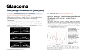 Glaucoma
Subtypingpatientsbeyondgenotyping
Hierarchical parameter
clustering/dendrogram for the
PACG subjects. Correlated
features are grouped in the
same cluster bounded by the
red box in the dendrogram. ACA,
anterior chamber area; ACD,
anterior chamber depth; ACV,
anterior chamber volume; ACW,
anterior chamber width; AL,
axial length; IArea, iris area;
ICurv, iris curvature; IT, iris
thickness; LV, lens vault; PD,
pupil diameter.
We identified three distinct subgroups of primary angle-closure glaucoma
(PACG) subjects based on anterior segment optical coherence tomography
(ASOCT) imaging. This study shows that PACG eyes can also be divided into
three distinct subgroups. However, the proportional distribution of PACG eyes
acrossthesubgroupswasdifferentfromPACS.
http://dx.doi.org/10.1038/eye.2016.267
http://dx.doi.org/10.1016/j.ophtha.2013.05.028;Cited by20 articles
Clustering analysis identified 3 distinct subgroups of PACS subjects based on ASOCT and
biometric parameters. These findings may be relevant for understanding angle-closure
pathogenesis and management. Additional research is needed to see whether customized
treatment protocols for angle-closure disease based on subcategorization can improve
the outcomesof patientswith angle-closure.
 