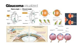 Glaucoma visualized
 