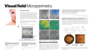 Visualfield Microperimetry
Microperimetry|VisualField
Right eye of a 72-year-old man. Native en-face
image (A) and reticular drusen (RDR) area
highlighted (B). Interpolated test results for both
scotopic (C) and photopic (D) microperimetry.
Numerical values for scotopic (E) and photopic
(F) microperimetry. Steinberg et al. (2015)
http://dx.doi.org/10.1167/iovs.08
-2926
http://dx.doi.org/10.
1167/tvst.3.5.3
(Top) Humphrey Field Analyzer (10-2 pattern, SITA Standard) and (bottom)
MP-1 microperimetry (10-2 pattern, 4-2 strategy) results from a normal
individual (age 29).
In summary there is an increasing amount of evidence supporting the
usefulness of microperimetry both as a clinical instrument and as a
research tool. The clinician should however be aware of the differences
between microperimetry and conventional perimetry, differences in the
manufacturer’s design that may affect testing conditions and therefore,
the interpretation of results. The advantages over conventional perimetry
include fundus tracking features and the co-registration of the perimetric
results with fundus imaging.
Can J Ophthalmol. 2013 Oct; 48(5): 358–363.
doi: 10.1016/j.jcjo.2013.03.021
 