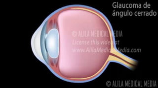 GLAUCOMA POR CIERRE ANGULAR AGUDO.pptx