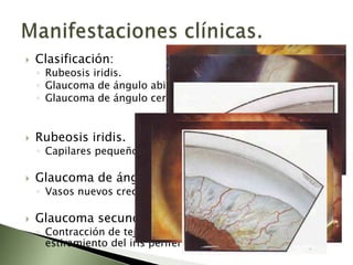 Subtle Rubeosis Glaucoma por pseudoexfoliación y neovascular | PPTX