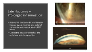 Late glaucoma –
Prolonged inflammation
• Inadequate control of the inflammation
induced by e.g. retained lens material,
viscoelastic, pre-existing uveitis, HSV
uveitis.
• Can lead to posterior synechiae and
peripheral anterior synechiae.
PAS
Retained lens material
 