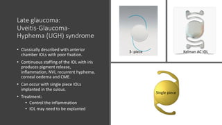 Late glaucoma:
Uveitis-Glaucoma-
Hyphema (UGH) syndrome
• Classically described with anterior
chamber IOLs with poor fixation.
• Continuous staffing of the IOL with iris
produces pigment release,
inflammation, NVI, recurrent hyphema,
corneal oedema and CME.
• Can occur with single piece IOLs
implanted in the sulcus.
• Treatment:
• Control the inflammation
• IOL may need to be explanted
Single piece
3-piece
Kelman AC IOL3- piece
 
