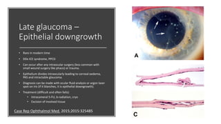 Late glaucoma –
Epithelial downgrowth
• Rare in modern time
• DDx ICE syndrome, PPCD
• Can occur after any intraocular surgery (less common with
small wound surgery like phaco) or trauma.
• Epithelium divides intraocularly leading to corneal oedema,
PAS and intractable glaucoma.
• Diagnosis can be made with ocular fluid analysis or argon laser
spot on iris (if it blanches, it is epithelial downgrowth).
• Treatment (difficult and often fails):
• Intracameral 5-FU, b-radiation, cryo
• Excision of involved tissue
Case Rep Ophthalmol Med. 2015;2015:325485
 