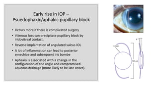 Early rise in IOP –
Psuedophakic/aphakic pupillary block
• Occurs more if there is complicated surgery
• Vitreous loss can precipitate pupillary block by
iridovitreal contact.
• Reverse implantation of angulated sulcus IOL
• A lot of inflammation can lead to posterior
synechiae and subsequent iris bombe
• Aphakia is associated with a change in the
configuration of the angle and compromised
aqueous drainage (more likely to be late onset).
 