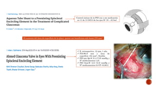  E. retrospectivo, 12 ojos, 1 año.
 IVA0.9 mm y área de
superficie 184 mm2., flexible.
 PIO pre Qx 31,4 (7,9) mmHg y
Nº medicamentos: 2,8.
 PIO final 12.5 (3.5) mmHg y
Nº medicamentos 0.8 (P <0.001).
El aumento del área de superficie de la placa parece ser beneficioso solo hasta 270 mm2
Control exitoso de la PIO con o sin medicación
en 11 de 13 (85%) de los ojos (S: 19 – 45.5m)
 