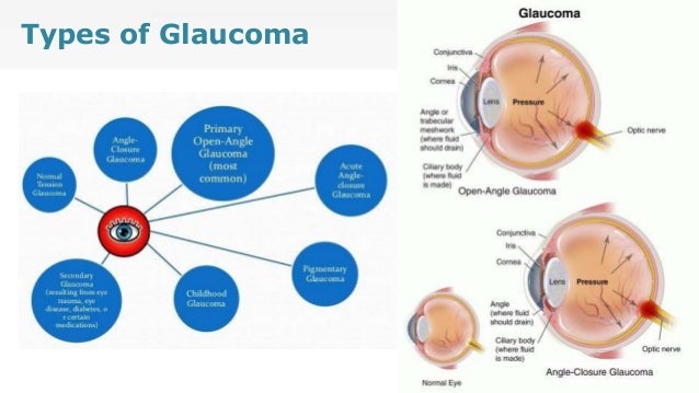 Glaucoma ppt Glaucoma ppt