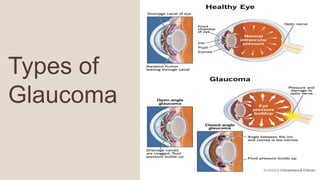 4
Types of
Glaucoma
 