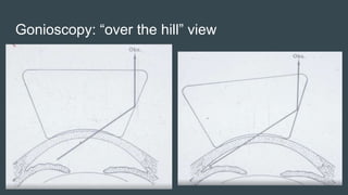 Gonioscopy: “over the hill” view
 