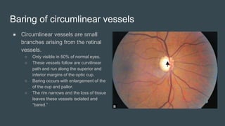 Baring of circumlinear vessels
● Circumlinear vessels are small
branches arising from the retinal
vessels.
○ Only visible in 50% of normal eyes.
○ These vessels follow are curvilinear
path and run along the superior and
inferior margins of the optic cup.
○ Baring occurs with enlargement of the
of the cup and pallor.
○ The rim narrows and the loss of tissue
leaves these vessels isolated and
“bared.”
 