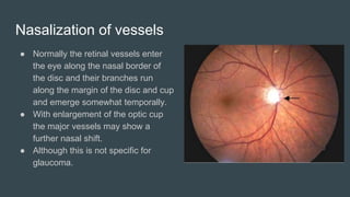 Nasalization of vessels
● Normally the retinal vessels enter
the eye along the nasal border of
the disc and their branches run
along the margin of the disc and cup
and emerge somewhat temporally.
● With enlargement of the optic cup
the major vessels may show a
further nasal shift.
● Although this is not specific for
glaucoma.
 