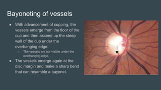 Bayoneting of vessels
● With advancement of cupping, the
vessels emerge from the floor of the
cup and then ascend up the steep
wall of the cup under the
overhanging edge.
○ The vessels are not visible under the
overhanging edge.
● The vessels emerge again at the
disc margin and make a sharp bend
that can resemble a bayonet.
 