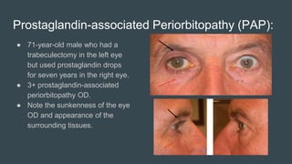 Prostaglandin-associated Periorbitopathy (PAP):
● 71-year-old male who had a
trabeculectomy in the left eye
but used prostaglandin drops
for seven years in the right eye.
● 3+ prostaglandin-associated
periorbitopathy OD.
● Note the sunkenness of the eye
OD and appearance of the
surrounding tissues.
 