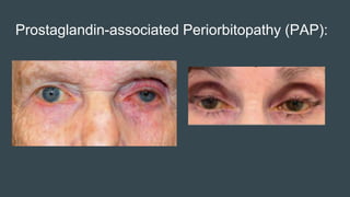 Prostaglandin-associated Periorbitopathy (PAP):
 