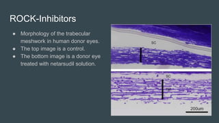 ROCK-Inhibitors
● Morphology of the trabecular
meshwork in human donor eyes.
● The top image is a control.
● The bottom image is a donor eye
treated with netarsudil solution.
 