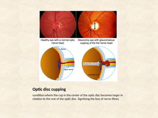 glaucoma presentation. . | PPTX