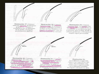 Glaucoma primario de angulo cerrado | PPTX