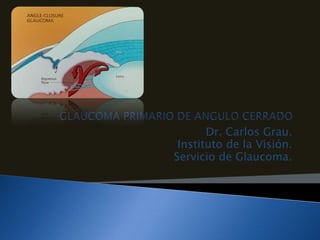 GLAUCOMA PRIMARIO DE ANGULO CERRADO Dr. Carlos Grau. Instituto de la Visión. Servicio de Glaucoma. 