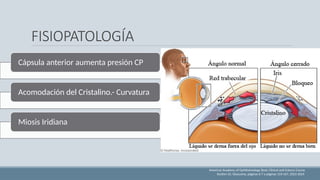 GLAUCOMA PRIMARIO DE ÁNGULO CERRADO.pptx