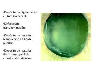 Depósito de pigmento en endotelio corneal.