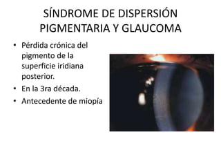 Defectos de transiluminación.