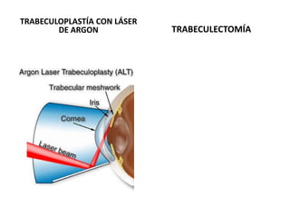Depósito de material blanquecino en borde pupilar.