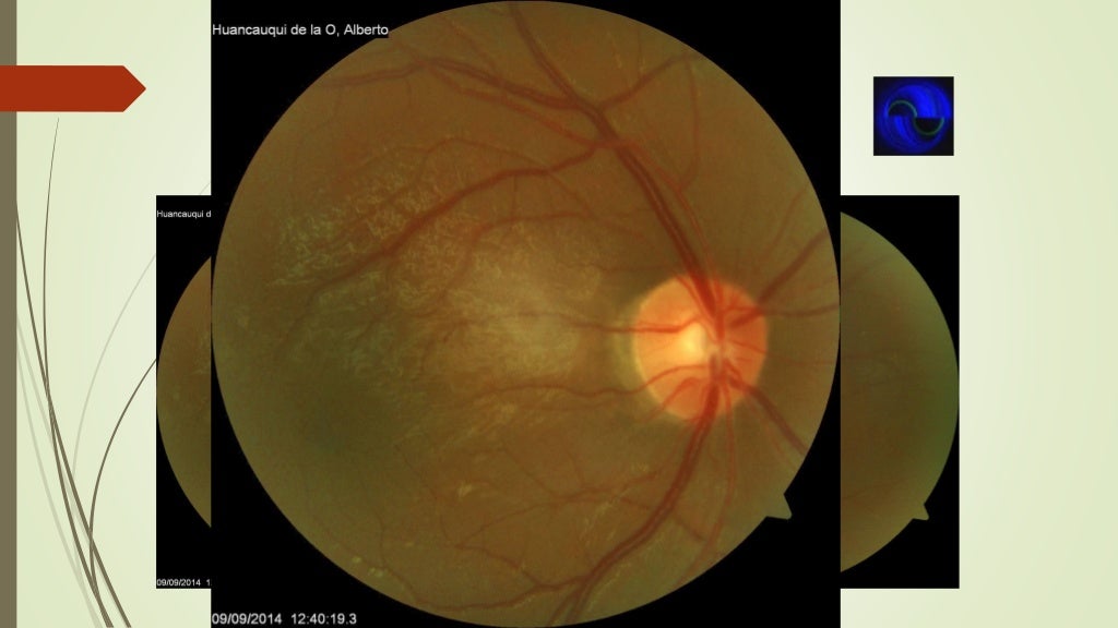 secundario a corticoides Steroidinduced