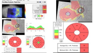 OS
OD
PanoMap Analysis: Right Eye
Signal Strength:
Technician: 10/10
Operator, Cirrus 9/10
86 µm
Inferior RNFL Thickness
81 µm
Superior RNFL Thickness
70 µm
Average RNFL Thickness
0.491 mm³
Cup Volume
0.78
Vertical C/D Ratio
0.80
Average C/D Ratio
0.76 mm²
Rim Area
2.17 mm²
Disc Area
Macular Thickness
50
Minimum GCL + IPL Thickness
57
Average GCL + IPL Thickness
RNFL Thickness
GCL + IPL
Combined GCA and RNFL Deviation Map
50
Minimum GCL + IPL Thickness
57
Average GCL + IPL Thickness
GCL + IPL
50
Minimum GCL + IPL Thickness
57
Average GCL + IPL Thickness
GCL + IPL
 