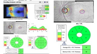 OS
OD
PanoMap Analysis: Left Eye
Signal Strength:
Technician: 10/10
Operator, Cirrus 10/10
134 µm
Inferior RNFL Thickness
172 µm
Superior RNFL Thickness
114 µm
Average RNFL Thickness
0.347 mm³
Cup Volume
0.57
Vertical C/D Ratio
0.69
Average C/D Ratio
1.15 mm²
Rim Area
2.14 mm²
Disc Area
Macular Thickness
82
Minimum GCL + IPL Thickness
87
Average GCL + IPL Thickness
RNFL Thickness
GCL + IPL
Combined GCA and RNFL Deviation Map
 
