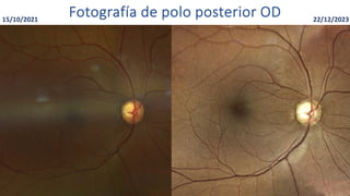 15/10/2021
Fotografía de polo posterior OD 22/12/2023
 