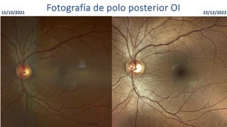 15/10/2021
Fotografía de polo posterior OI 22/12/2023
 