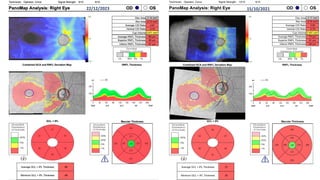 OS
OD
PanoMap Analysis: Right Eye
Signal Strength:
Technician: 10/10
Operator, Cirrus 9/10
86 µm
Inferior RNFL Thickness
81 µm
Superior RNFL Thickness
70 µm
Average RNFL Thickness
0.491 mm³
Cup Volume
0.78
Vertical C/D Ratio
0.80
Average C/D Ratio
0.76 mm²
Rim Area
2.17 mm²
Disc Area
Macular Thickness
50
Minimum GCL + IPL Thickness
57
Average GCL + IPL Thickness
RNFL Thickness
GCL + IPL
Combined GCA and RNFL Deviation Map
22/12/2023 15/10/2021
 