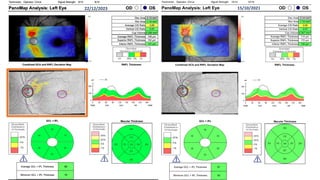 OS
OD
PanoMap Analysis: Left Eye
Signal Strength:
Technician: 10/10
Operator, Cirrus 10/10
134 µm
Inferior RNFL Thickness
172 µm
Superior RNFL Thickness
114 µm
Average RNFL Thickness
0.347 mm³
Cup Volume
0.57
Vertical C/D Ratio
0.69
Average C/D Ratio
1.15 mm²
Rim Area
2.14 mm²
Disc Area
Macular Thickness
82
Minimum GCL + IPL Thickness
87
Average GCL + IPL Thickness
RNFL Thickness
GCL + IPL
Combined GCA and RNFL Deviation Map
22/12/2023 15/10/2021
 