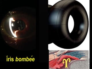 íris bombée
 