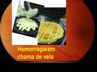 Hemorragiaem
chama de vela
 