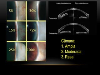 Câmara:
1. Ampla
2. Moderada
3. Rasa
 