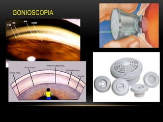 GONIOSCOPIA
 