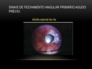 SINAIS DE FECHAMENTO ANGULAR PRIMÁRIO AGUDO
PRÉVIO.
Atrofia setorial de íris
 