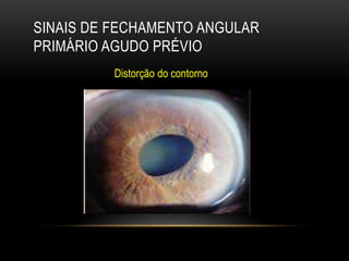 SINAIS DE FECHAMENTO ANGULAR
PRIMÁRIO AGUDO PRÉVIO
Distorção do contorno
 