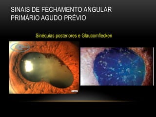 SINAIS DE FECHAMENTO ANGULAR
PRIMÁRIO AGUDO PRÉVIO
Sinéquias posteriores e Glaucomflecken
.
 