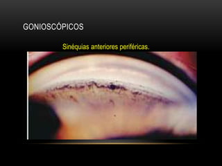 GONIOSCÓPICOS
Sinéquias anteriores periféricas.
 