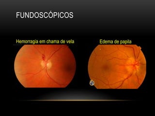 FUNDOSCÓPICOS
Hemorragia em chama de vela Edema de papila
.
 