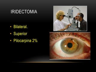 IRIDECTOMIA
• Bilateral.
• Superior
• Pilocarpina 2%
 