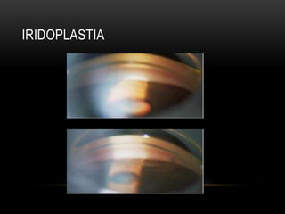 IRIDOPLASTIA
 