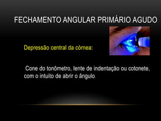 FECHAMENTO ANGULAR PRIMÁRIO AGUDO
Depressão central da córnea:
Cone do tonômetro, lente de indentação ou cotonete,
com o intuito de abrir o ângulo.
 