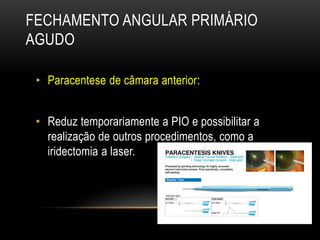 FECHAMENTO ANGULAR PRIMÁRIO
AGUDO
• Paracentese de câmara anterior:
• Reduz temporariamente a PIO e possibilitar a
realização de outros procedimentos, como a
iridectomia a laser.
 